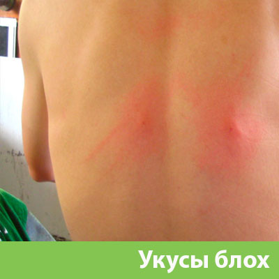 Укусы блох в Саратове