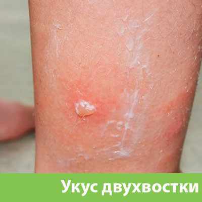 Укус двухвостки в Саратове