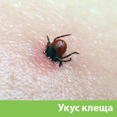 Укус клеща в Саратове