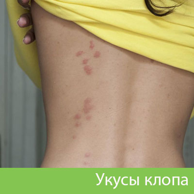 Профессиональное уничтожение клопов в Саратове
